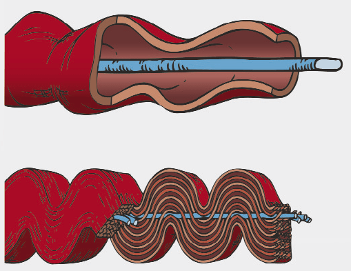 Das Bild zeigt eine Grafik mit zwei Konstruktionsweisen für elastische Arme bei einem Klettersteigset. Oben getrennte Fasern, unten gemeinsam verwobene lastragende und elastische Fasern. 